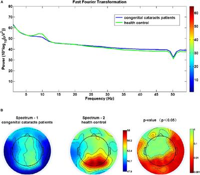 Reduced Functional Connectivity in Children With Congenital Cataracts Using Resting-State Electroencephalography Measurement